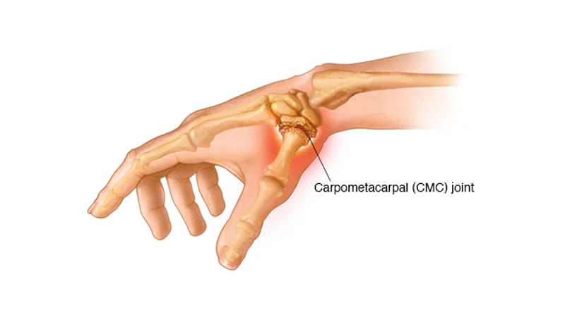 diagram explaining thumb CMC joint arthritis