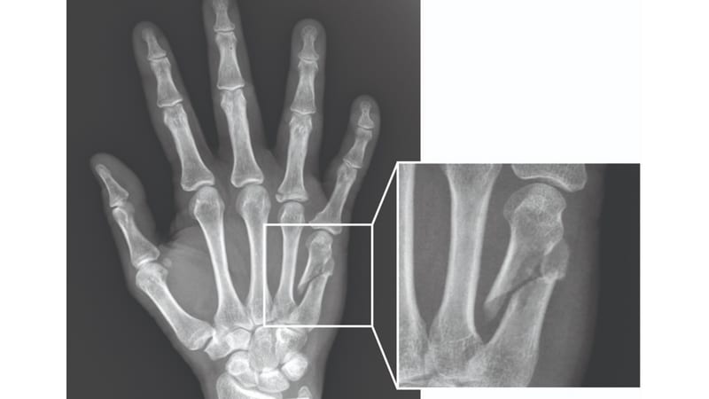 an x-ray of a hand fracture