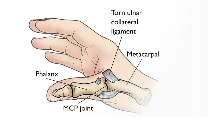 diagram showing an ulnar collateral ligament tear