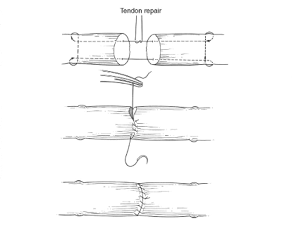a diagram explaining a tendon repair