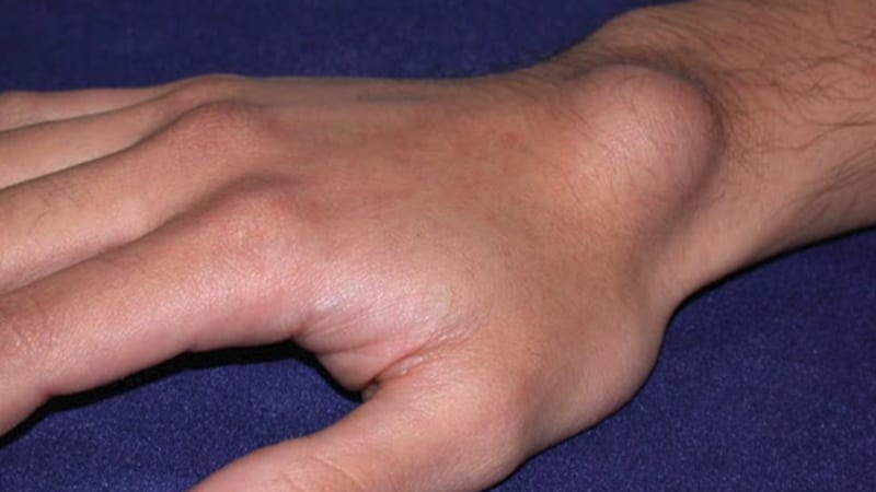 a picture of a ganglion cyst