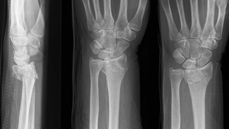 a distal radius fracture x-ray