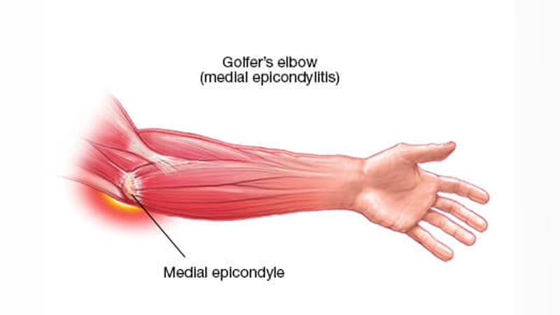 diagram explaining golfer's elbow