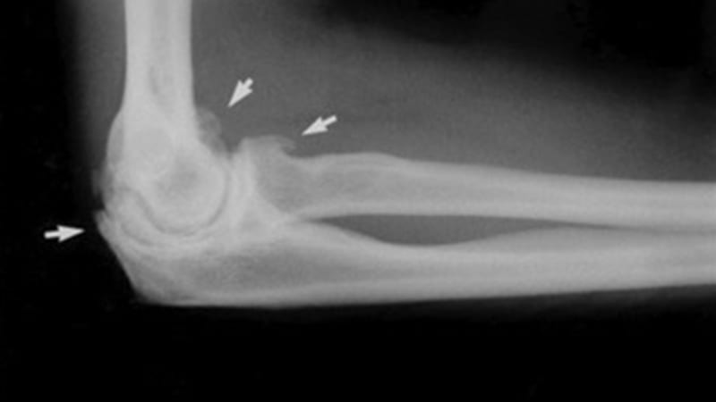 an x-ray showing elbow arthritis