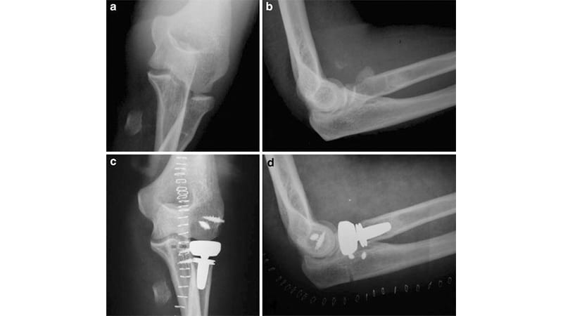4 x-rays showing elbow fractures and repairs