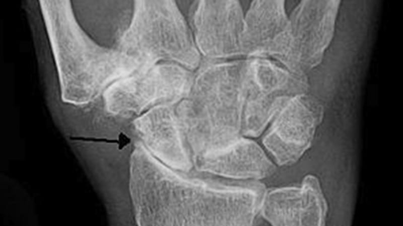 an x-ray showing wrist arthritis