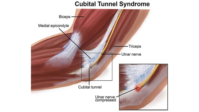 a diagram explaining cubital tunnel syndrome