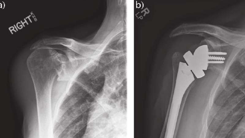 an x-ray showing correction of shoulder arthritis