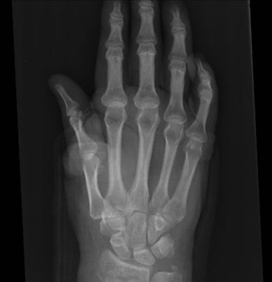 A picture of a distal radius fracture