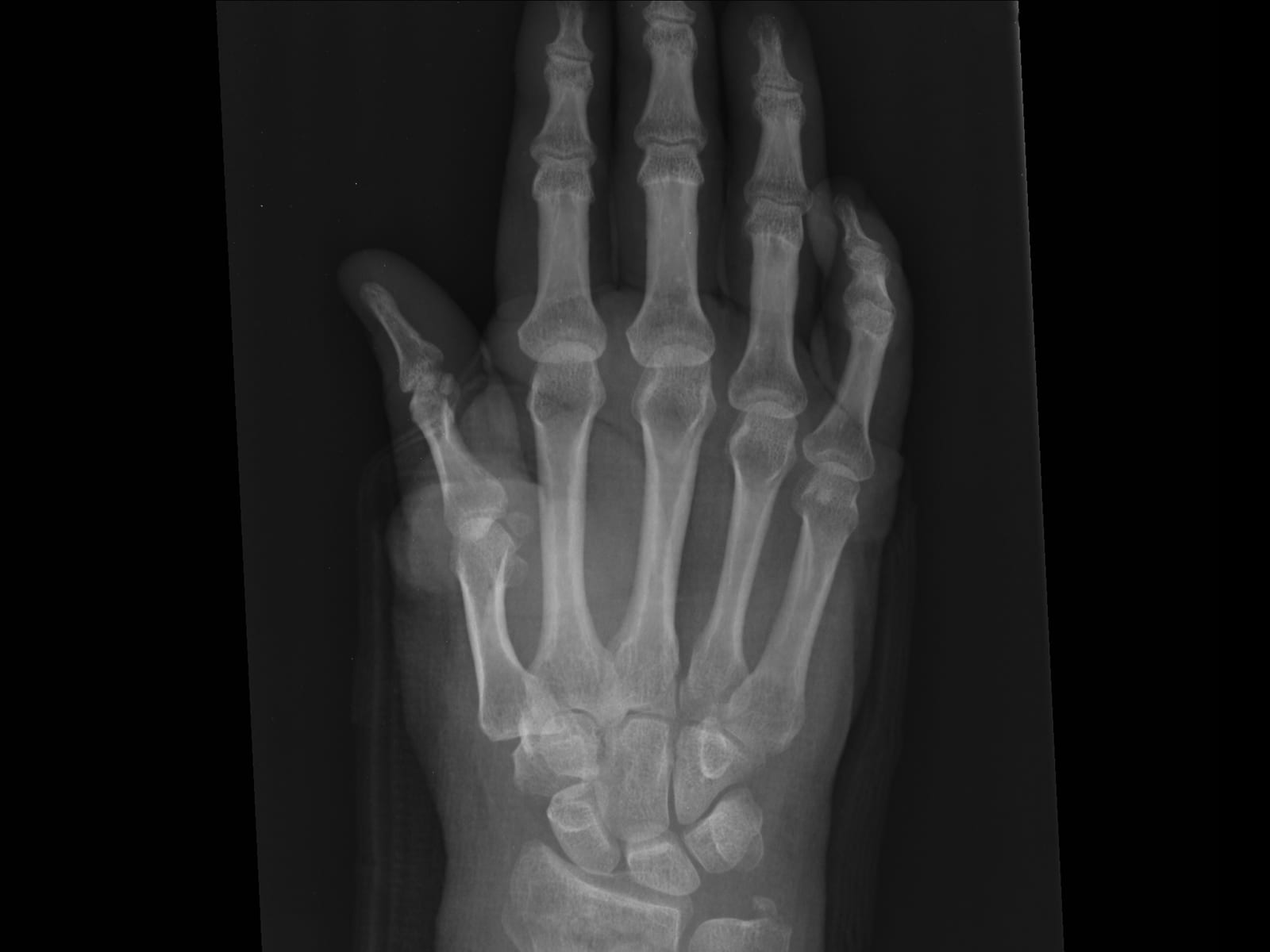 A picture of a distal radius fracture