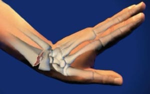 A bending wrist explain a distal radius fracture