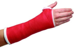 An arm in a cast showing conservative treatment of a distal radius fracture