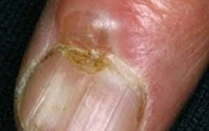 A digital mucous cyst under a thumb nail