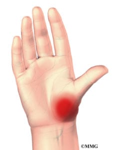 image showing pain in the thumb from osteoarthritis